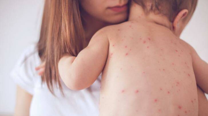 Measles can be particularly nasty for young children, NSW Health says. 